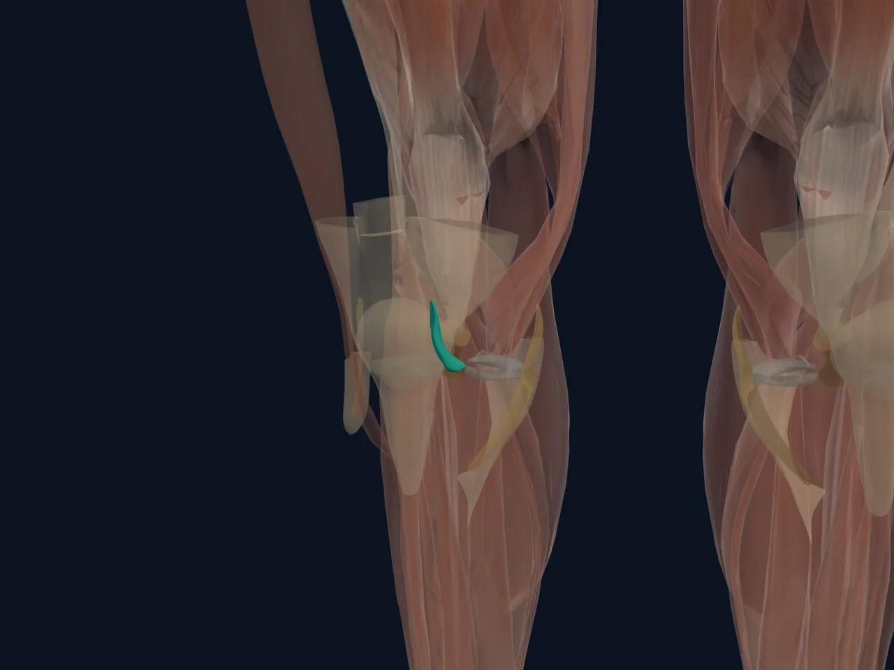Anterior Cruciate Ligament (ACL) highlighted in teal with nearby anatomy shown for orientation.