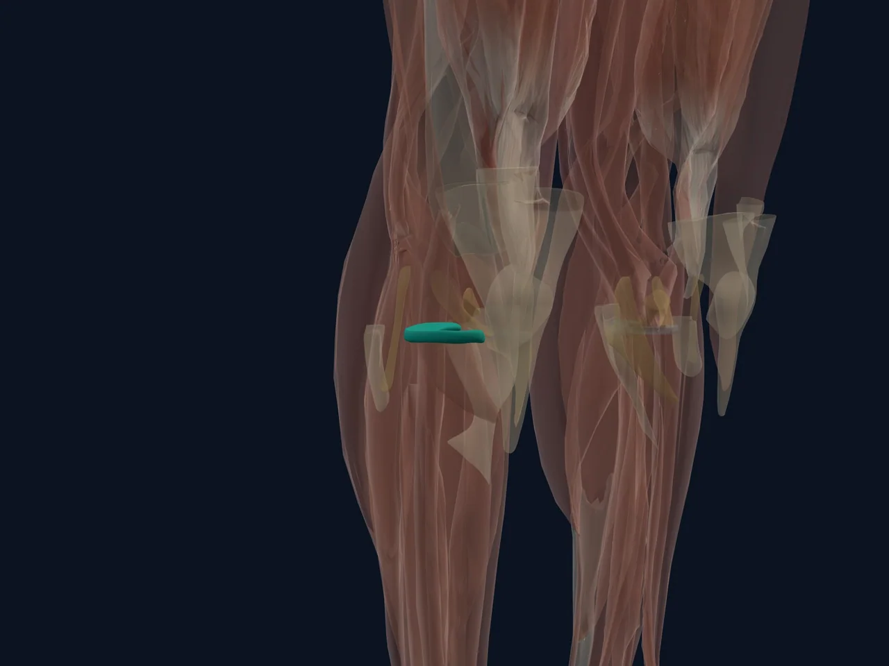 Lateral Meniscus highlighted in teal with nearby anatomy shown for orientation.