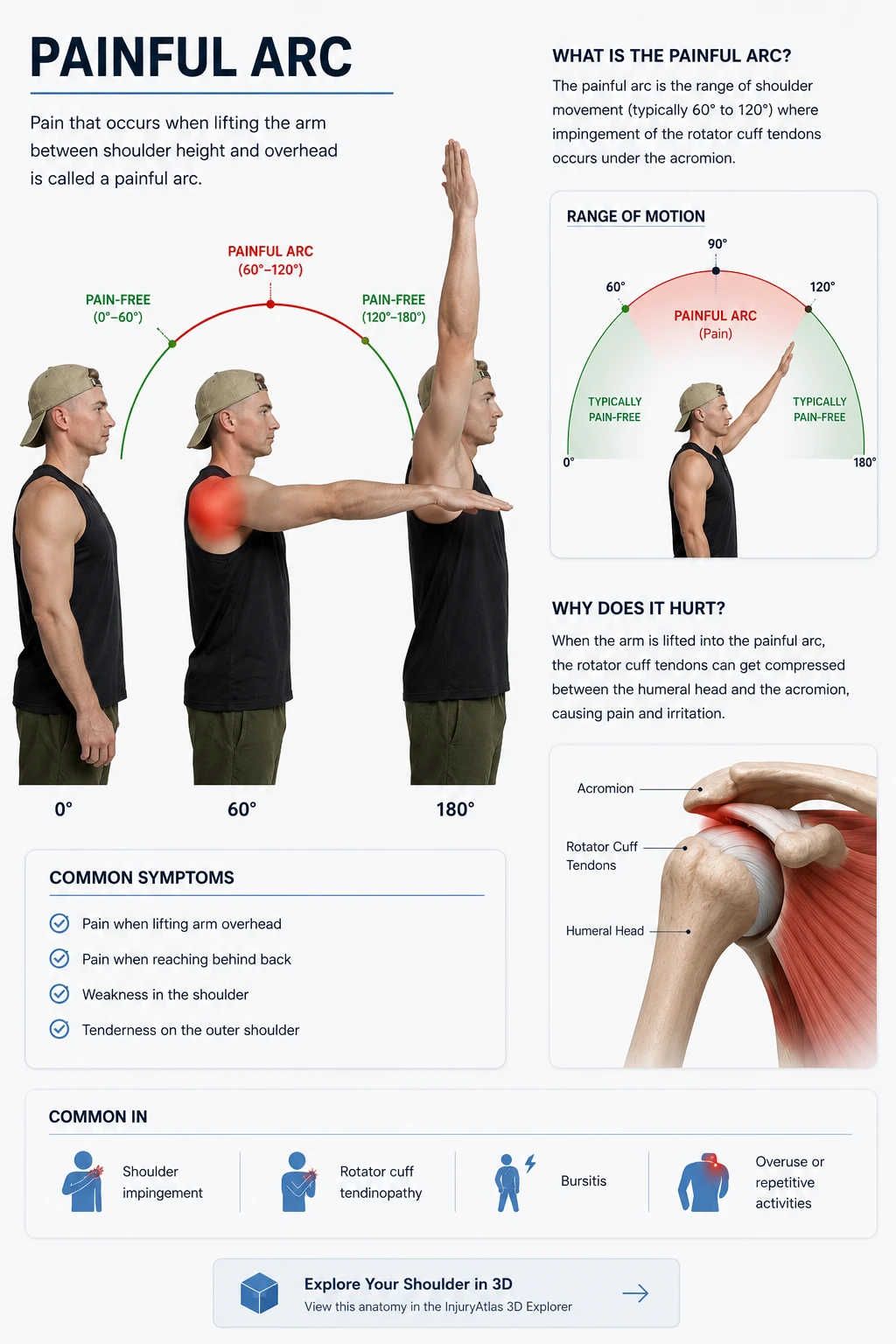 Illustration of the painful arc: arm positions from 0 degrees to 180 degrees, with pain highlighted between roughly 60 and 120 degrees, most noticeable through the middle portion of an overhead reach