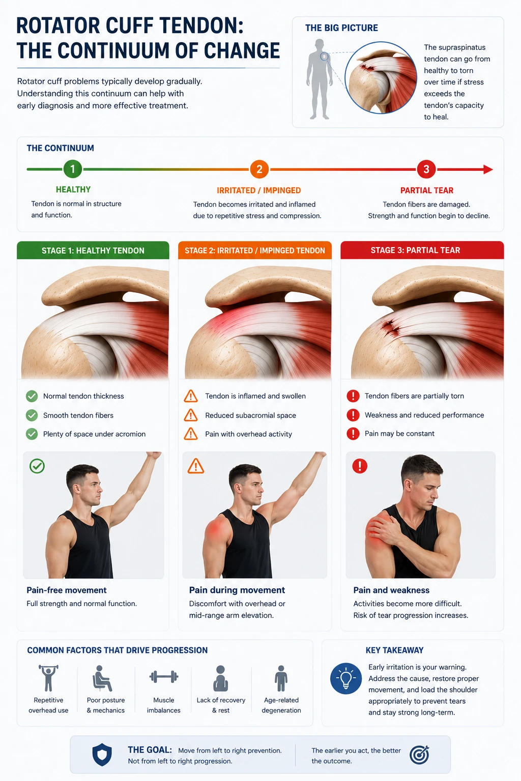 Three-stage diagram of the rotator cuff tendon continuum: a healthy tendon, an irritated and impinged tendon with reduced subacromial space, and a partial tear, illustrating that this progression is possible but not inevitable