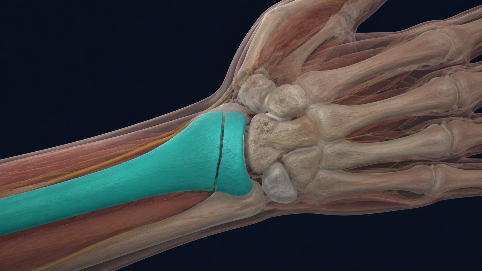 Wrist illustration with the distal radius and a fracture line highlighted in teal.
