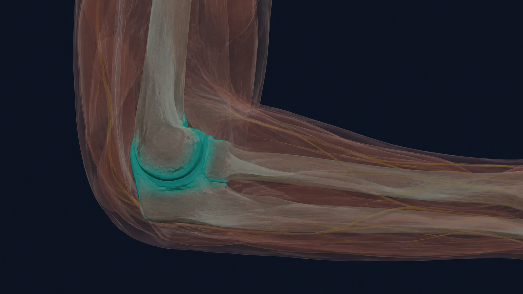 Side-view elbow illustration with narrowed joint surfaces highlighted.