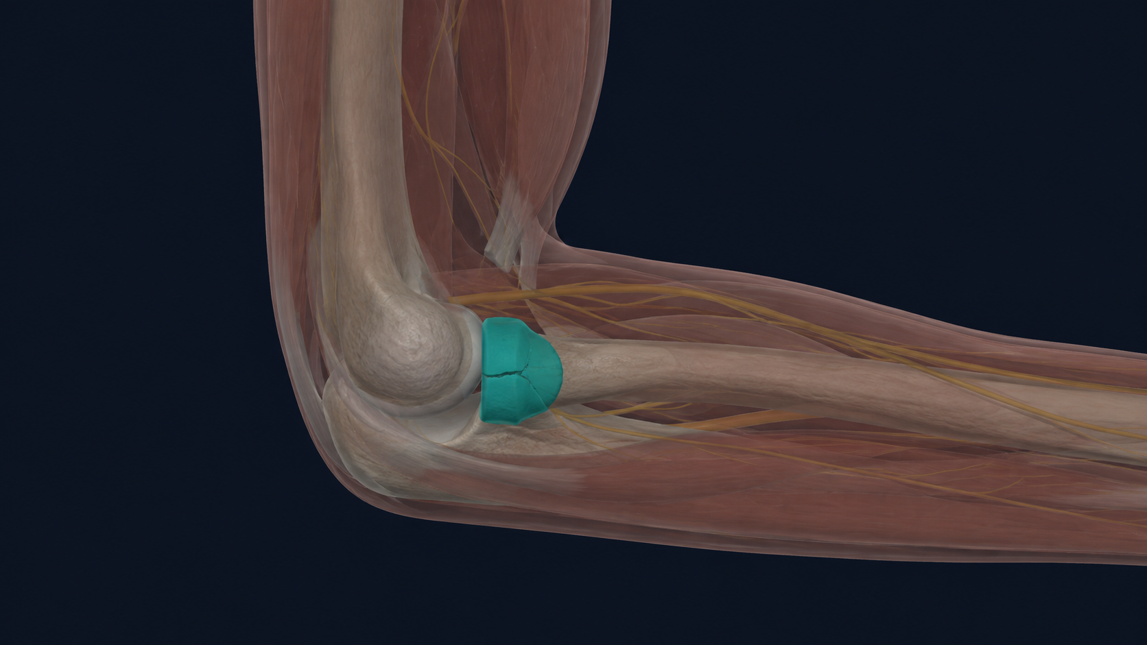 Side-view elbow illustration with a small fracture at the radial head highlighted.