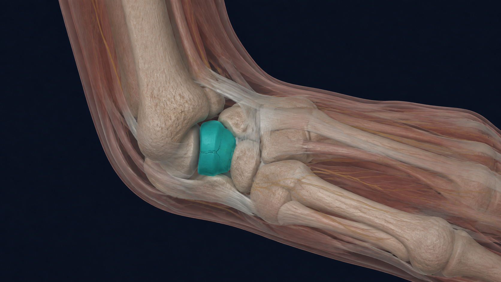 Wrist illustration with the scaphoid and a fracture line highlighted in teal.