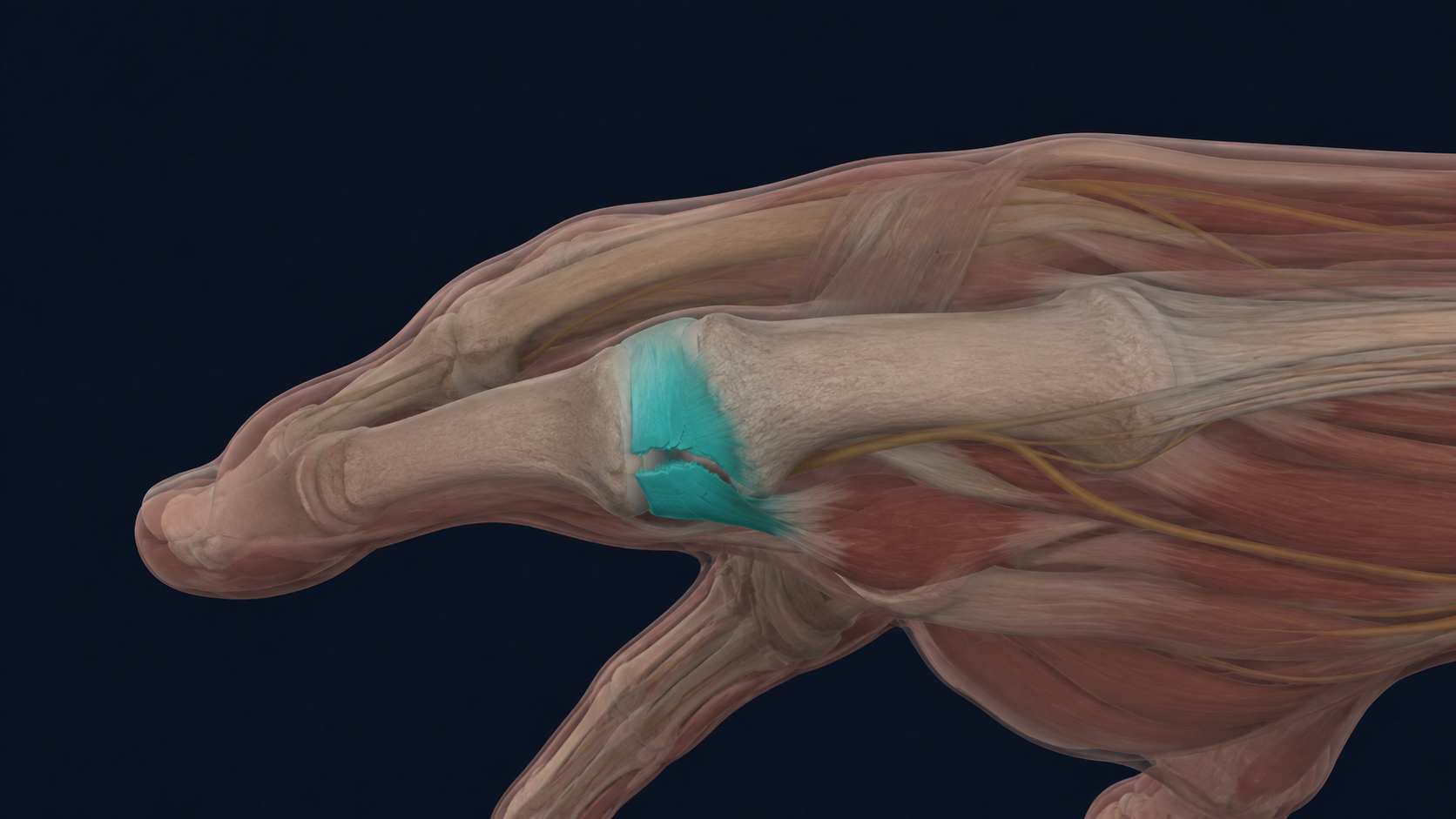 Thumb joint illustration with the ulnar collateral ligament and a partial tear highlighted in teal.